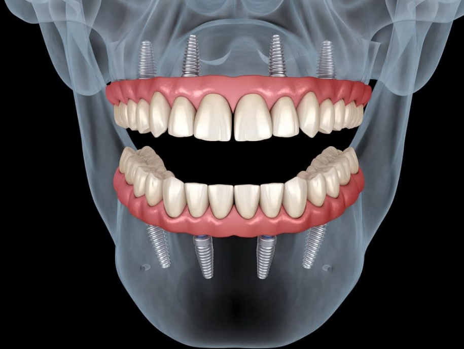 Procedura de implant dentar informatii esentiale de cunoscut