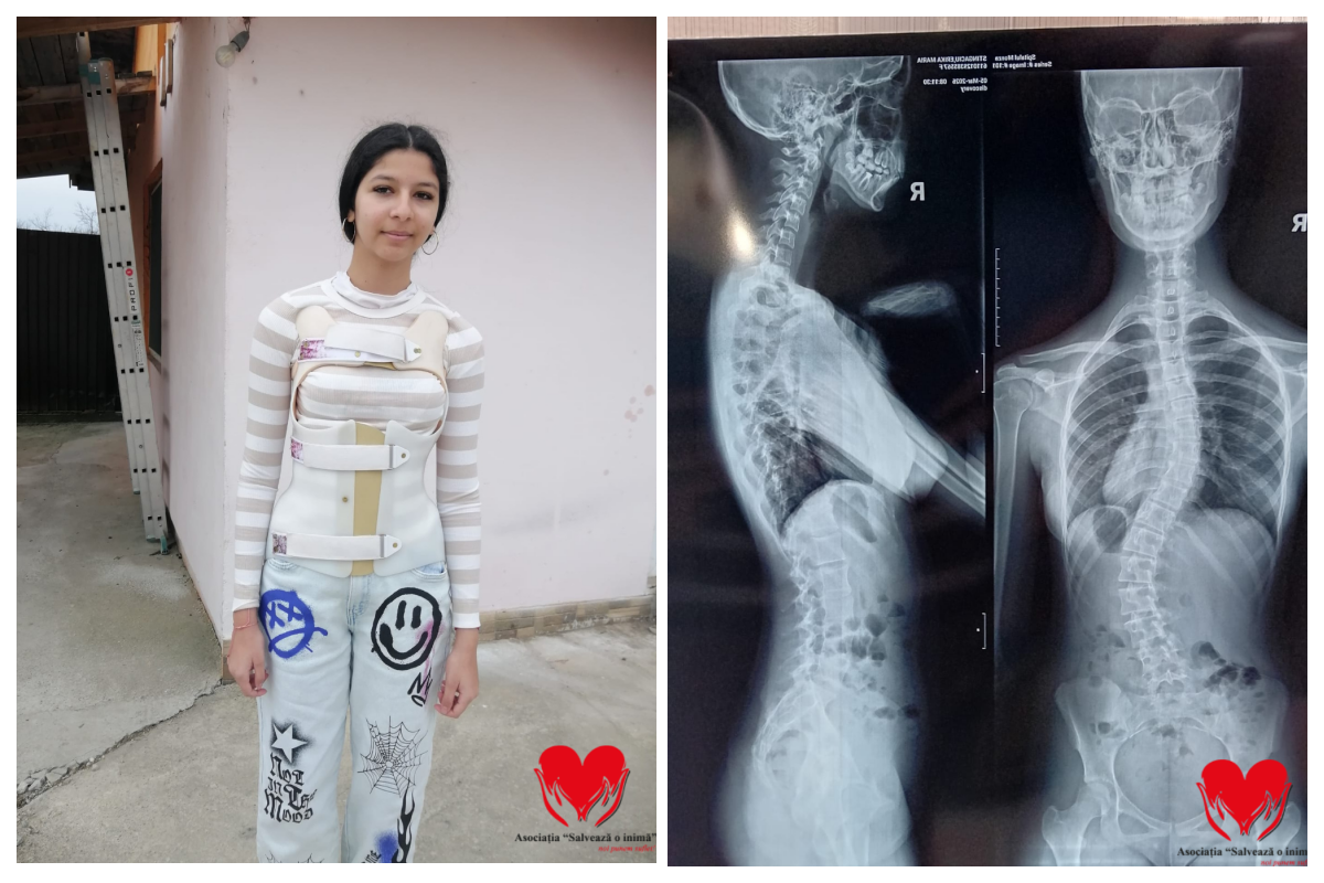Erika in varsta de doar 15 ani are nevoie urgenta de ajutorul vostru Fiecare zi imi indoiesc coloana Vreau sa merg la scoala Opsratie este sansa mea