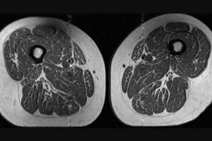 Alimentele ultraprocesate „transformă” mușchii în grăsime: avertisment dintr-un nou studiu