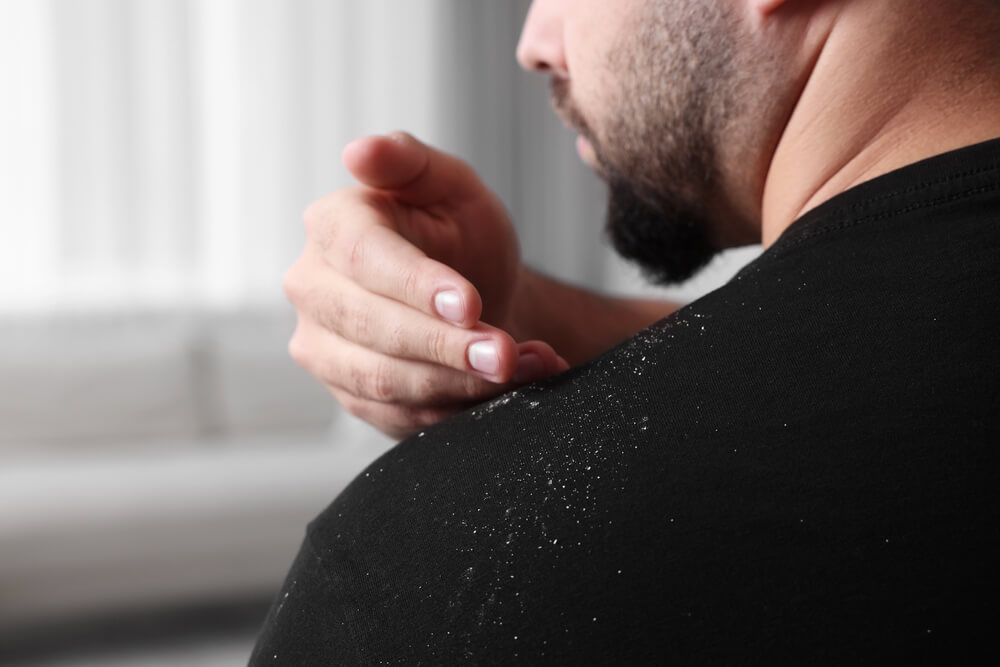 Sampon anti matreata cum functioneaza ingredientele active P